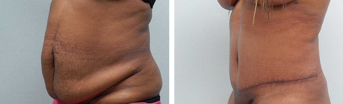Tummy Tuck Before & After Gallery - Patient 175416 - Image 4