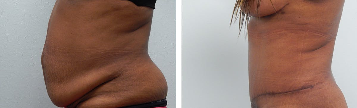 Liposuction Before & After Gallery - Patient 300533 - Image 5