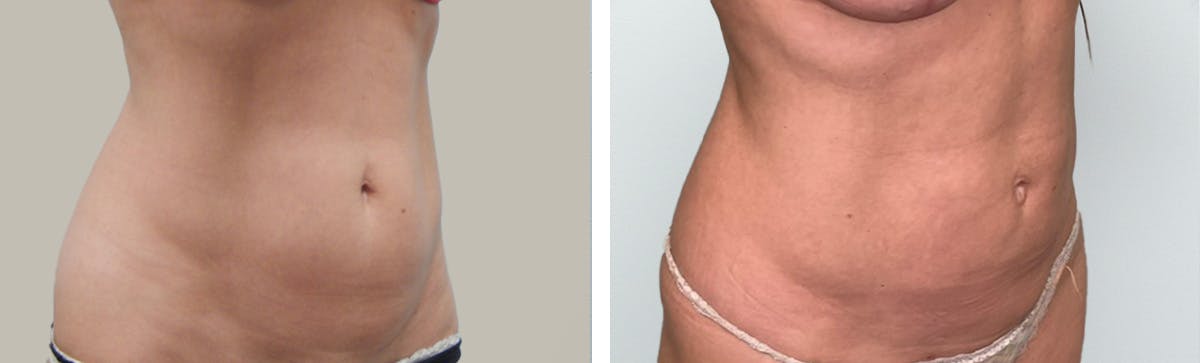 Liposuction Before & After Gallery - Patient 296818 - Image 1