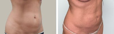 Liposuction Before & After Gallery - Patient 296818 - Image 1