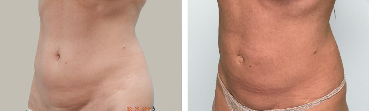 Liposuction Before & After Gallery - Patient 296818 - Image 2