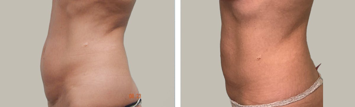 Liposuction Before & After Gallery - Patient 296818 - Image 3