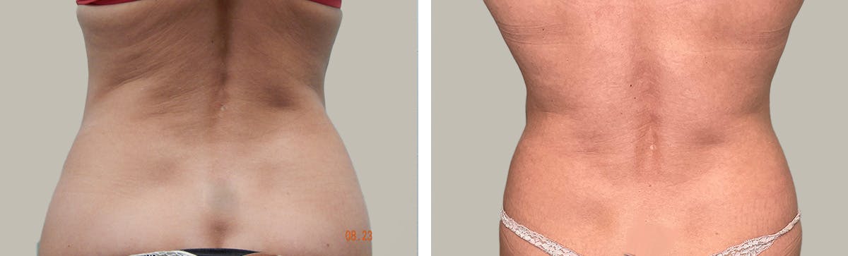 Liposuction Before & After Gallery - Patient 296818 - Image 4