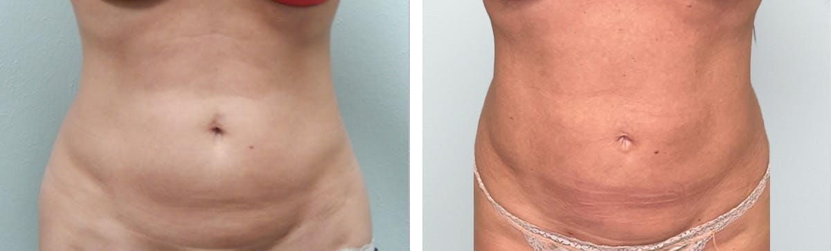 Liposuction Before & After Gallery - Patient 296818 - Image 5