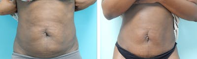 Tummy Tuck Before & After Gallery - Patient 353902 - Image 1