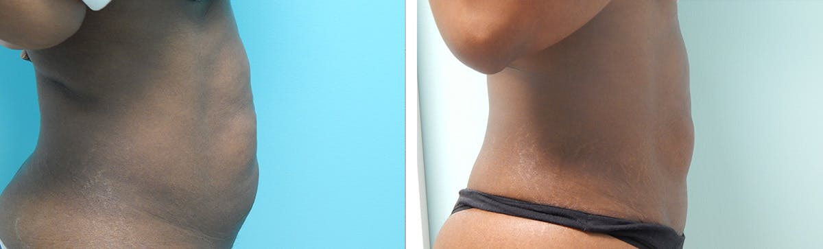 Tummy Tuck Before & After Gallery - Patient 353902 - Image 2