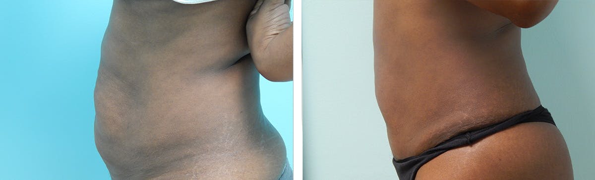Tummy Tuck Before & After Gallery - Patient 353902 - Image 3