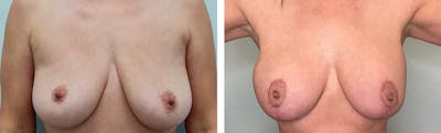 Breast Augmentation Before & After Gallery - Patient 270339 - Image 1