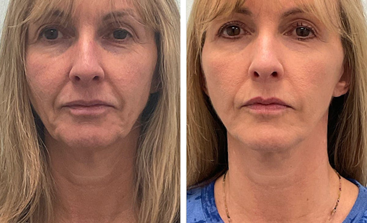 Modified Neck Lift Before & After Gallery - Patient 350828 - Image 1