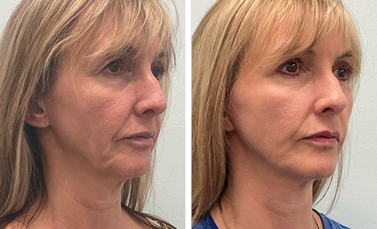 Modified Neck Lift Before & After Gallery - Patient 350828 - Image 2