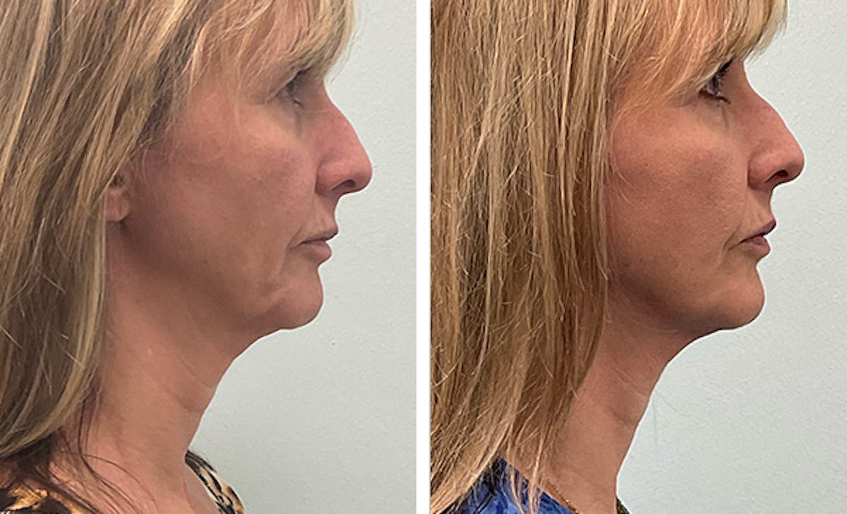 Modified Neck Lift Before & After Gallery - Patient 350828 - Image 3