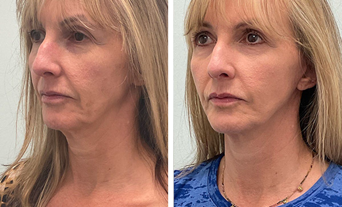 Modified Neck Lift Before & After Gallery - Patient 350828 - Image 4