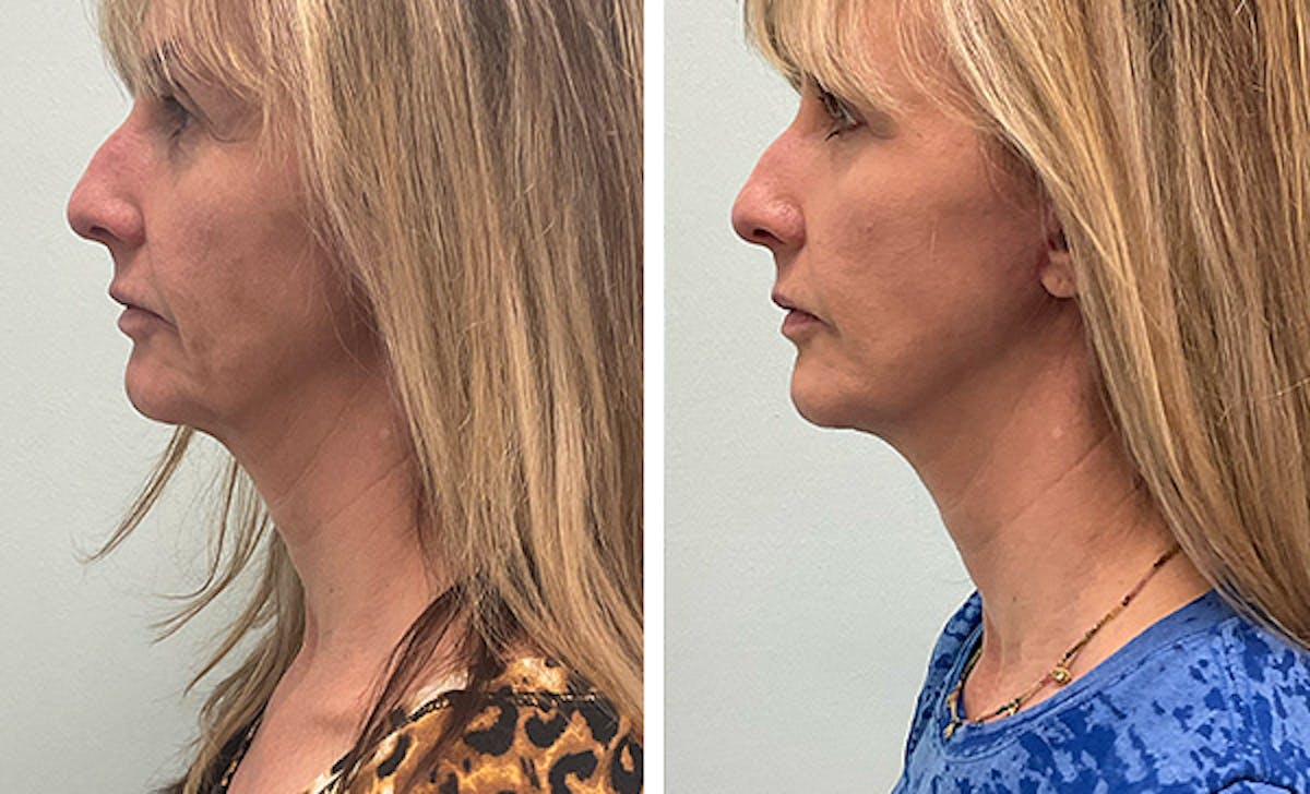 Modified Facelift Before & After Gallery - Patient 954370 - Image 5