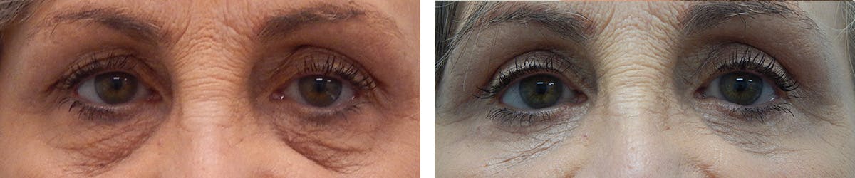 Eyelid Surgery Before & After Gallery - Patient 459841 - Image 1
