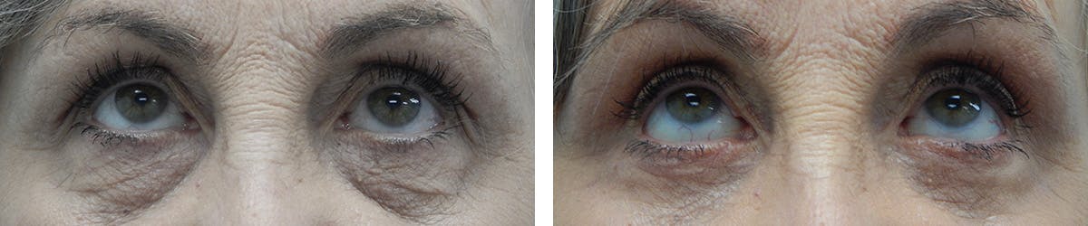 Eyelid Surgery Before & After Gallery - Patient 459841 - Image 2
