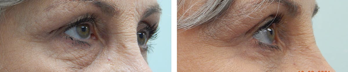 Eyelid Surgery Before & After Gallery - Patient 459841 - Image 3