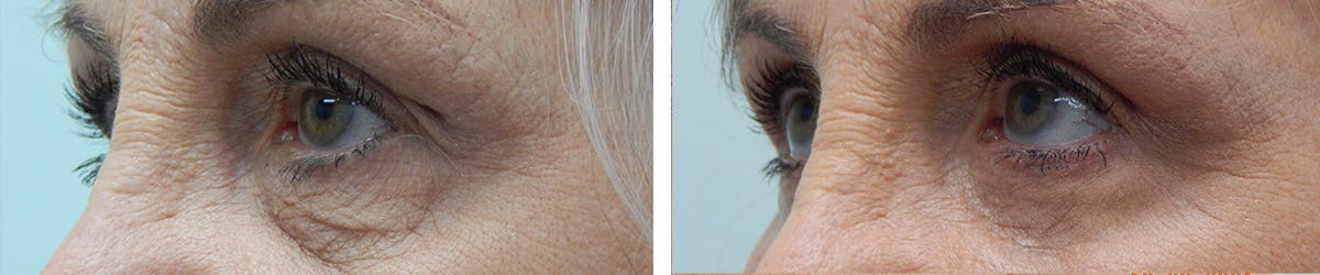 Eyelid Surgery Before & After Gallery - Patient 459841 - Image 4