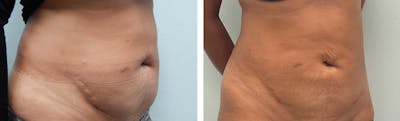 Liposuction Before & After Gallery - Patient 249681 - Image 1