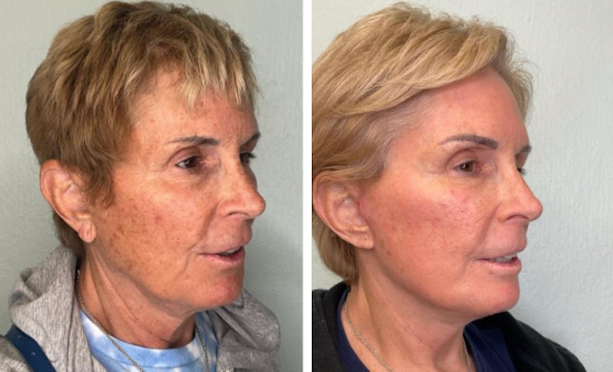 Modified Facelift Before & After Gallery - Patient 348928 - Image 1