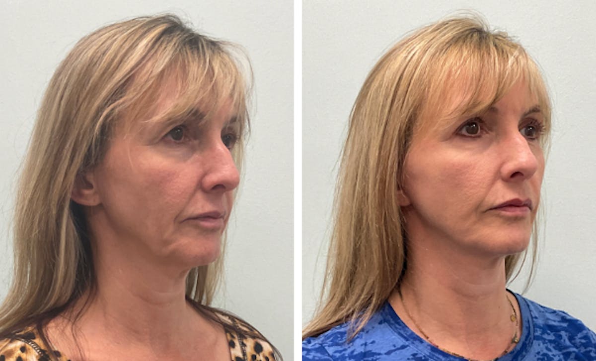 Modified Neck Lift Before & After Gallery - Patient 338296 - Image 1