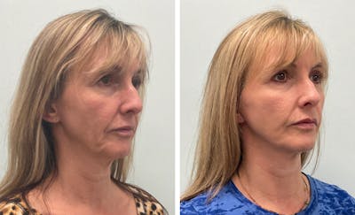 Modified Neck Lift Before & After Gallery - Patient 338296 - Image 1