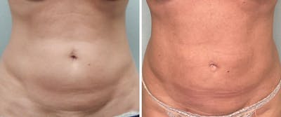Liposuction Before & After Gallery - Patient 383307 - Image 1