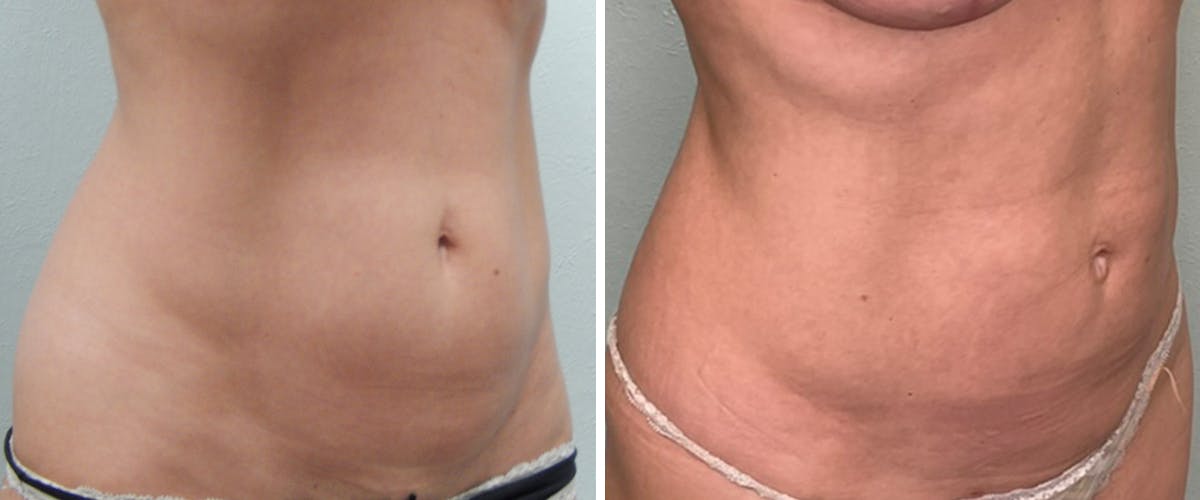 Liposuction Before & After Gallery - Patient 383307 - Image 2