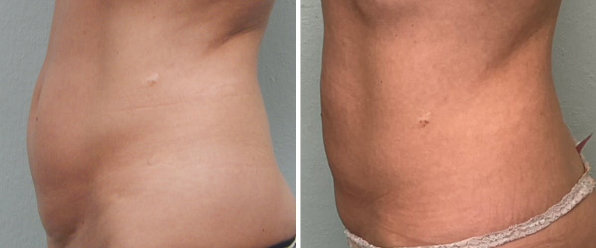 Liposuction Before & After Gallery - Patient 383307 - Image 3