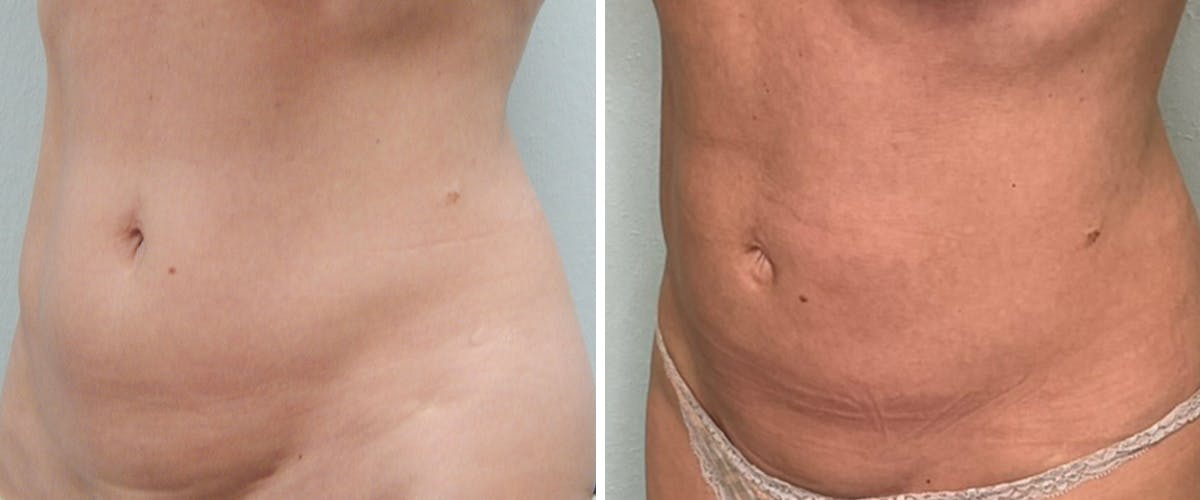 Liposuction Before & After Gallery - Patient 383307 - Image 4