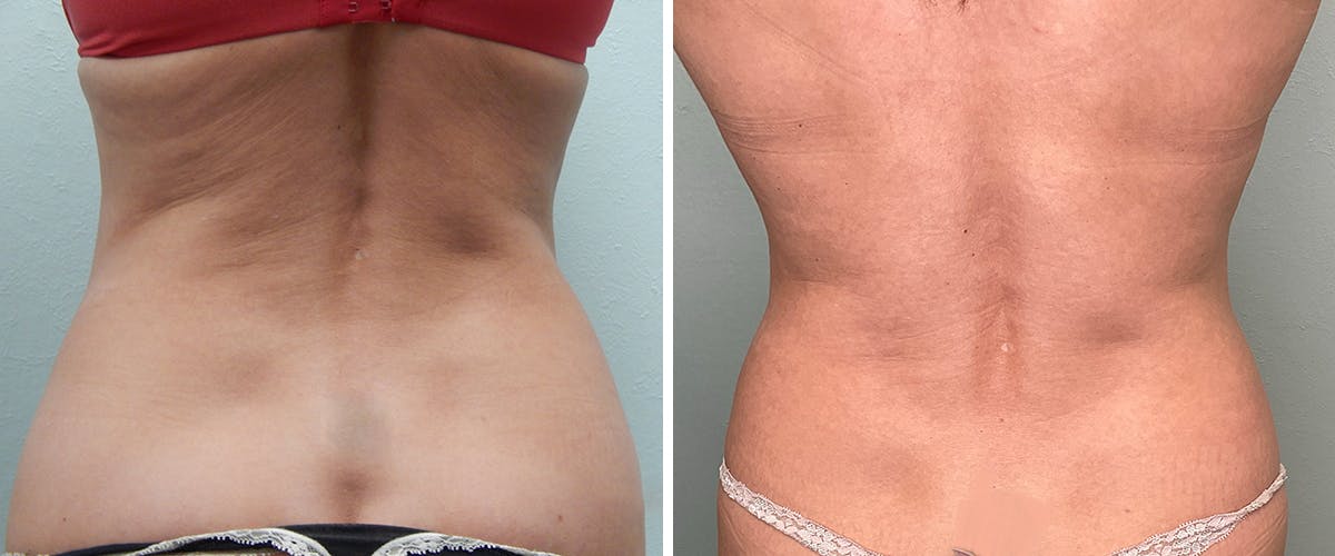 Liposuction Before & After Gallery - Patient 383307 - Image 5