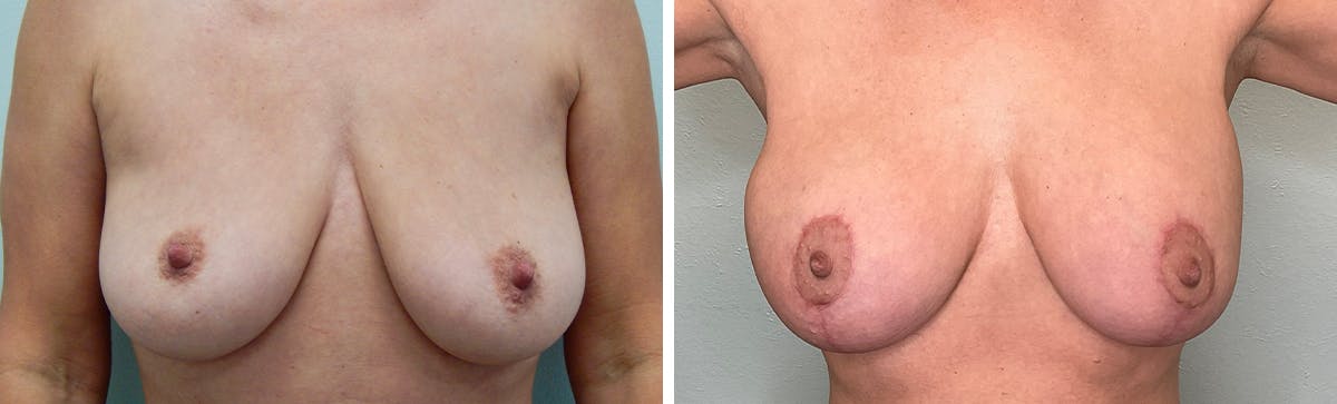 Breast Augmentation Before & After Gallery - Patient 334945 - Image 1