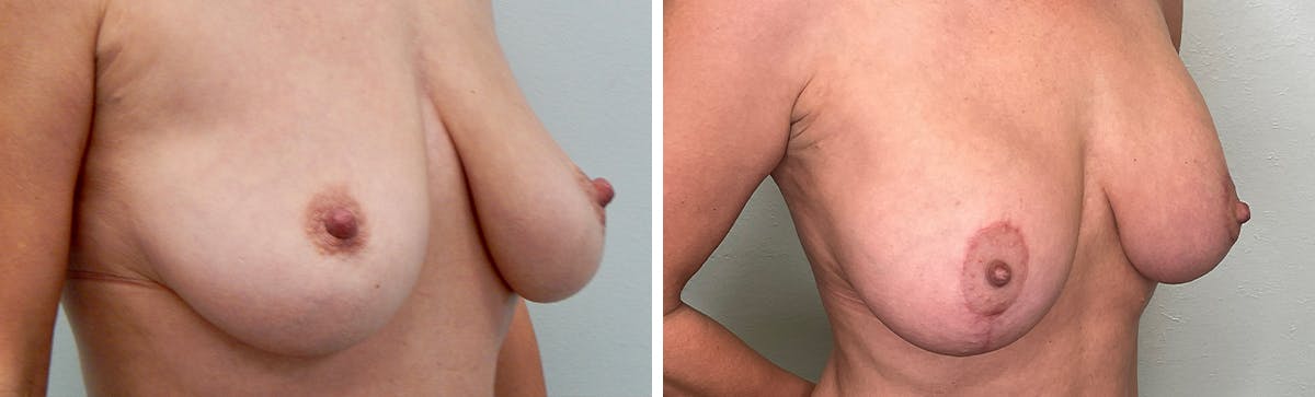 Breast Augmentation Before & After Gallery - Patient 334945 - Image 2