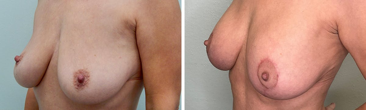Breast Augmentation Before & After Gallery - Patient 334945 - Image 3