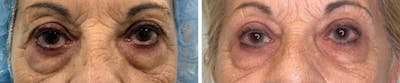 Eyelid Surgery Before & After Gallery - Patient 245374 - Image 1