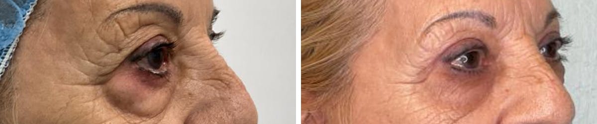 Eyelid Surgery Before & After Gallery - Patient 245374 - Image 2