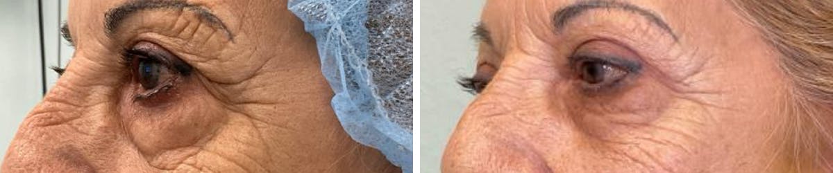 Eyelid Surgery Before & After Gallery - Patient 245374 - Image 4