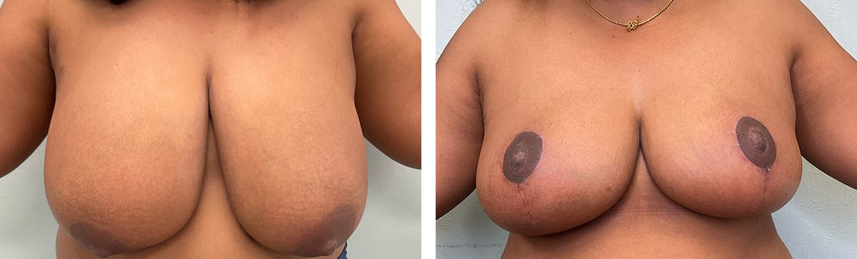 Breast Reduction Before & After Gallery - Patient 249674 - Image 1