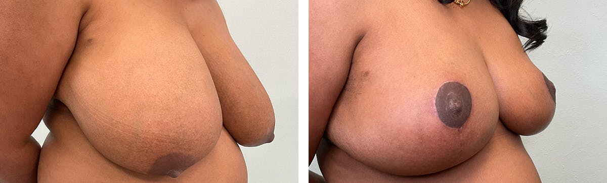 Breast Reduction Before & After Gallery - Patient 249674 - Image 2