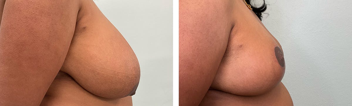 Breast Reduction Before & After Gallery - Patient 249674 - Image 3