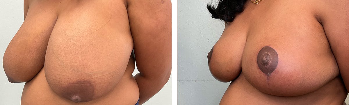 Breast Reduction Before & After Gallery - Patient 249674 - Image 4