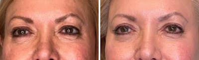 Eyelid Surgery Before & After Gallery - Patient 321676 - Image 1