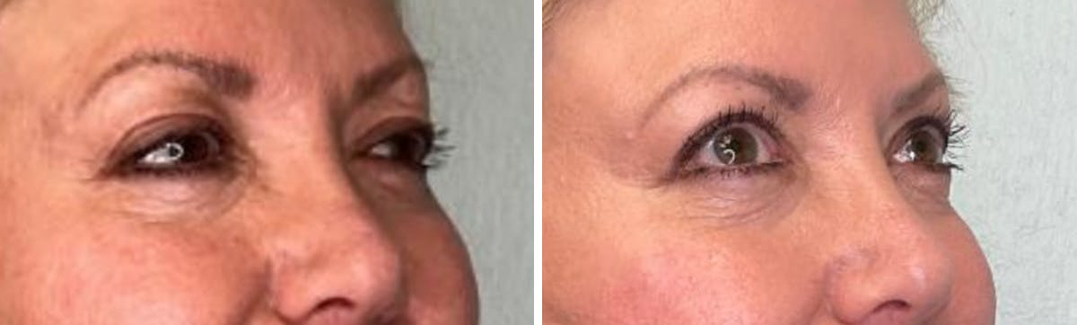 Eyelid Surgery Before & After Gallery - Patient 321676 - Image 2