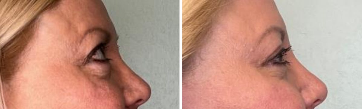 Eyelid Surgery Before & After Gallery - Patient 321676 - Image 3