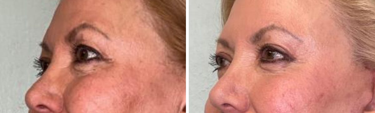 Eyelid Surgery Before & After Gallery - Patient 321676 - Image 4