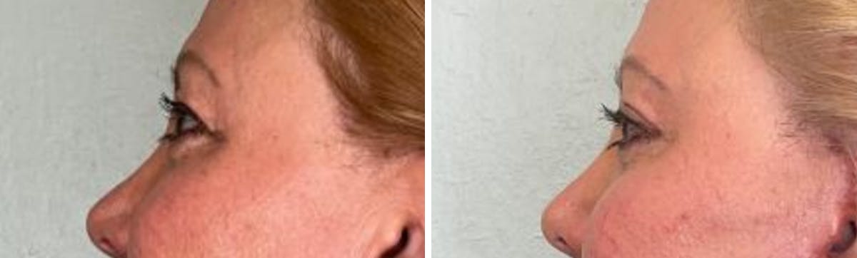 Eyelid Surgery Before & After Gallery - Patient 321676 - Image 5