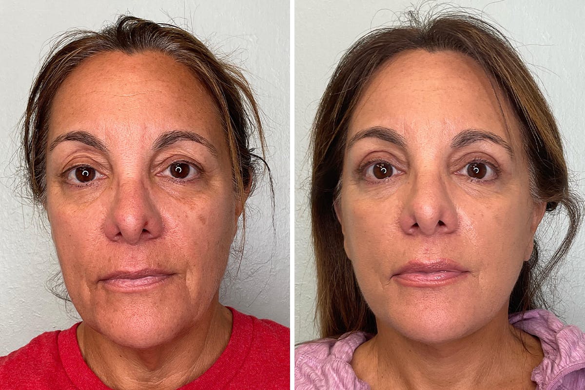 Modified Facelift Before & After Gallery - Patient 211213 - Image 1