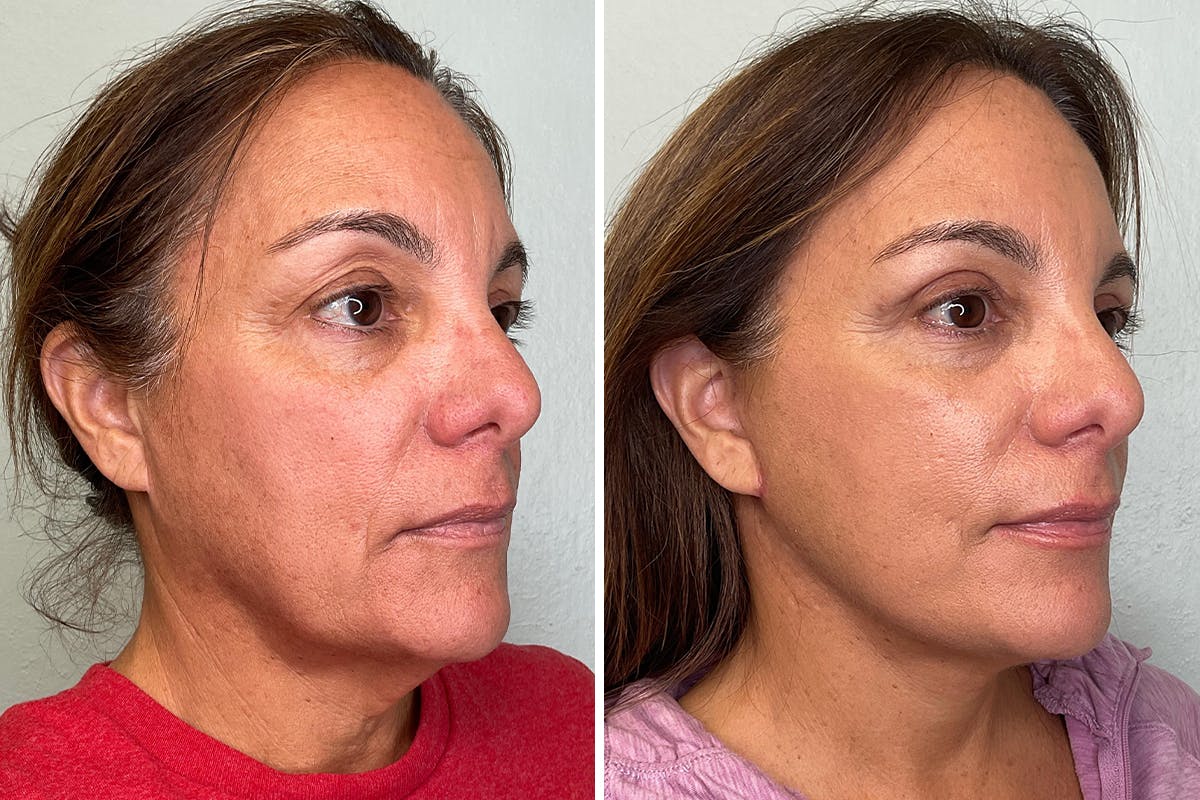 Modified Facelift Before & After Gallery - Patient 211213 - Image 2