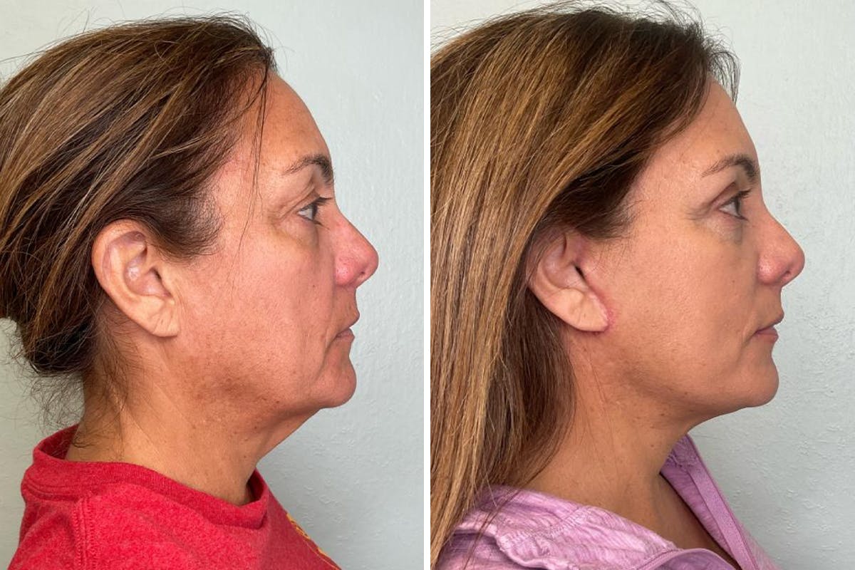 Modified Neck Lift Before & After Gallery - Patient 320871 - Image 3