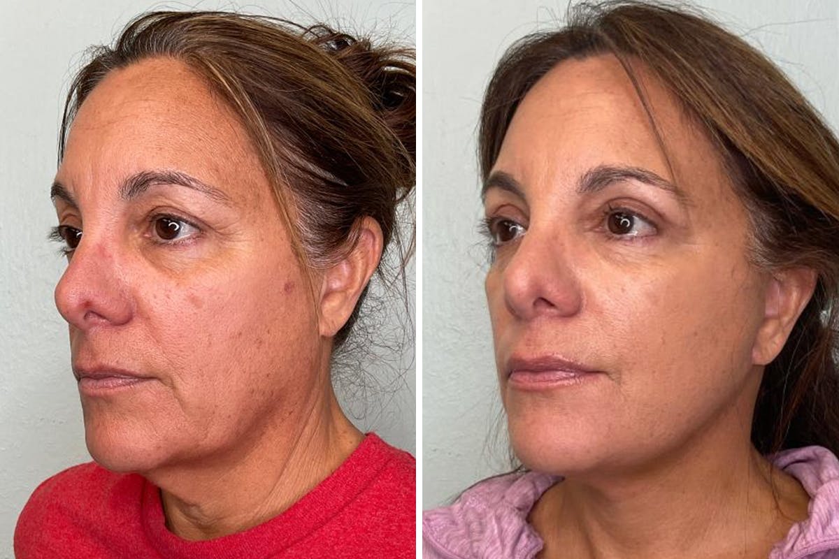 Modified Facelift Before & After Gallery - Patient 211213 - Image 4