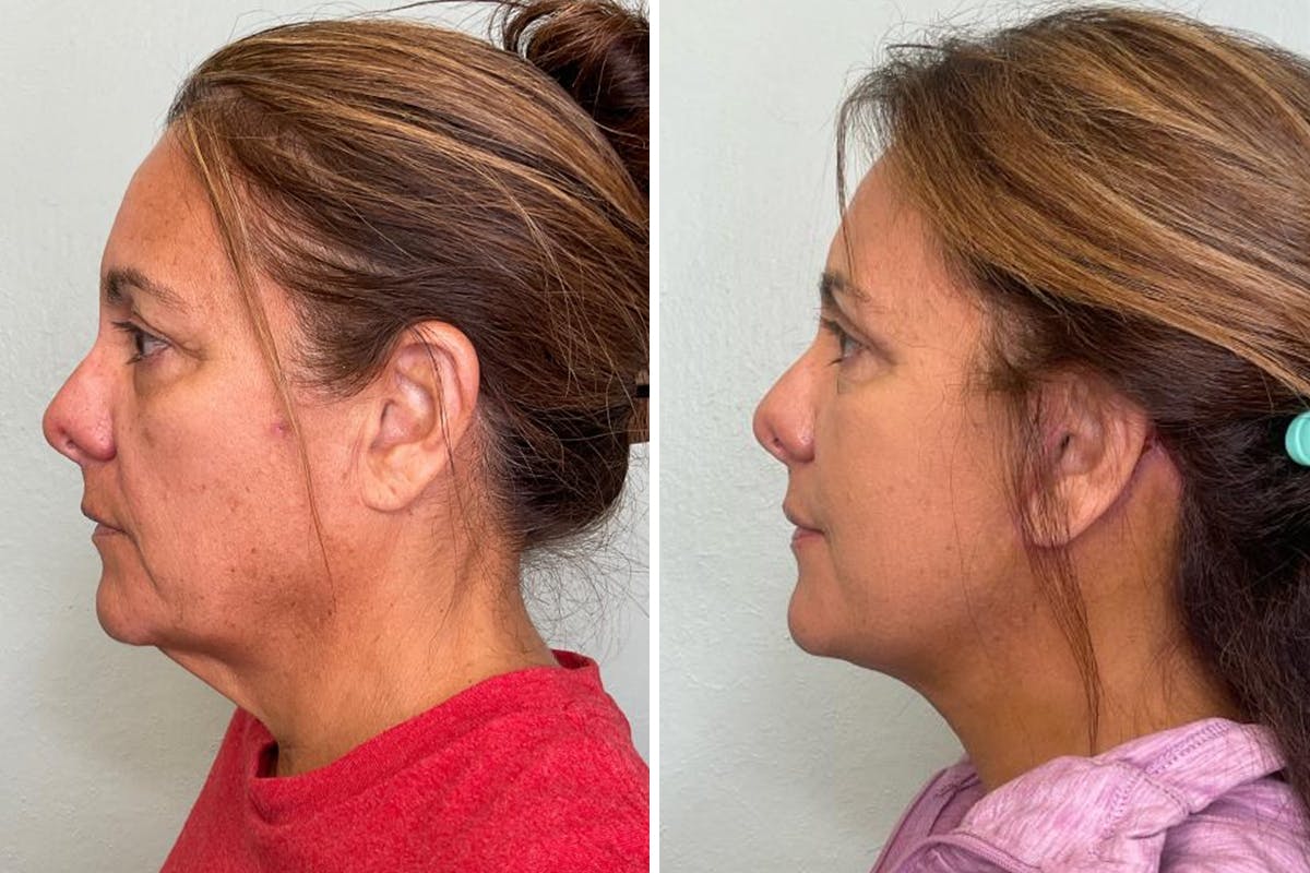 Modified Facelift Before & After Gallery - Patient 211213 - Image 5